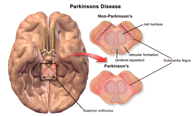 File:Blausen 0704 ParkinsonsDisease.png - Wikimedia Commons