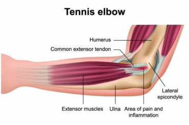 The Best Ways To Treat Tennis Elbow