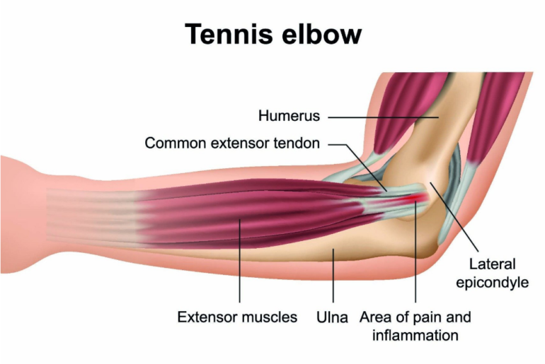 The Best Ways To Treat Tennis Elbow The Best Ways To Treat Tennis Elbow