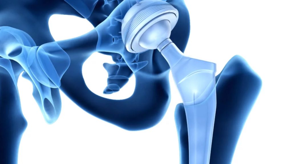 Everything you Need to Know About Hip Revision Surgery