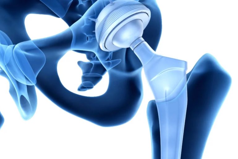 Everything you Need to Know About Hip Revision Surgery