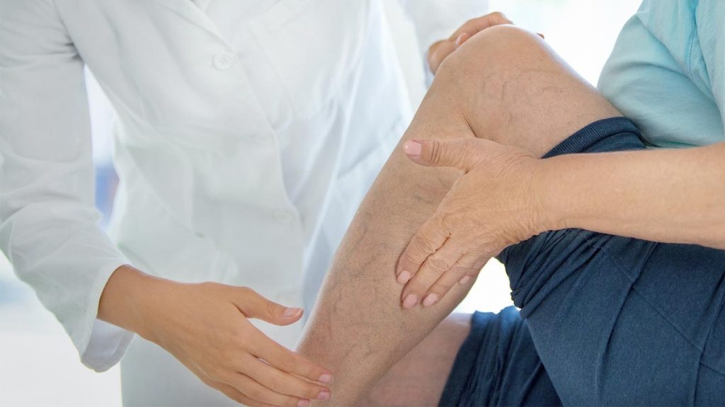 Varicose Veins Management and Treatment