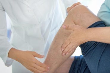 Varicose Veins Management and Treatment