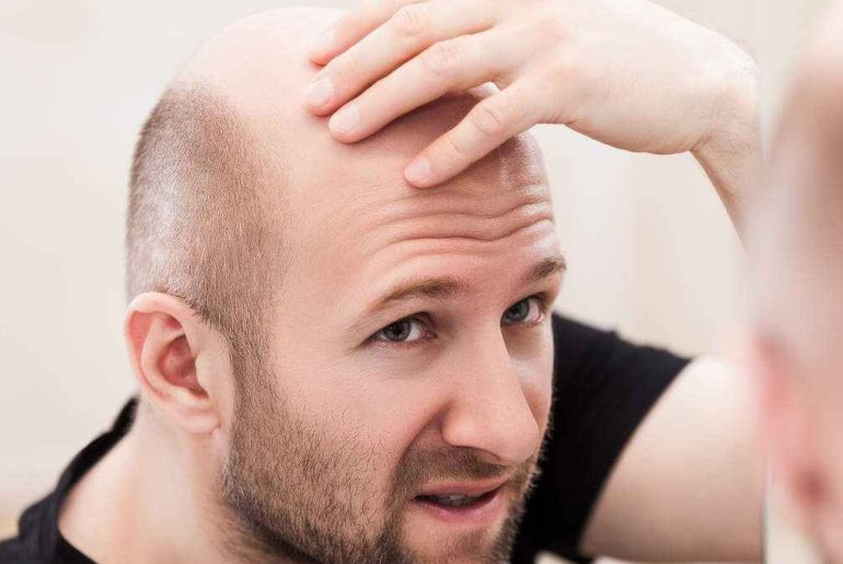 5 Treatment Options For Hair Loss