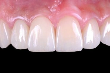 Dental Restoration Different Types of Aesthetic Dental Fillings