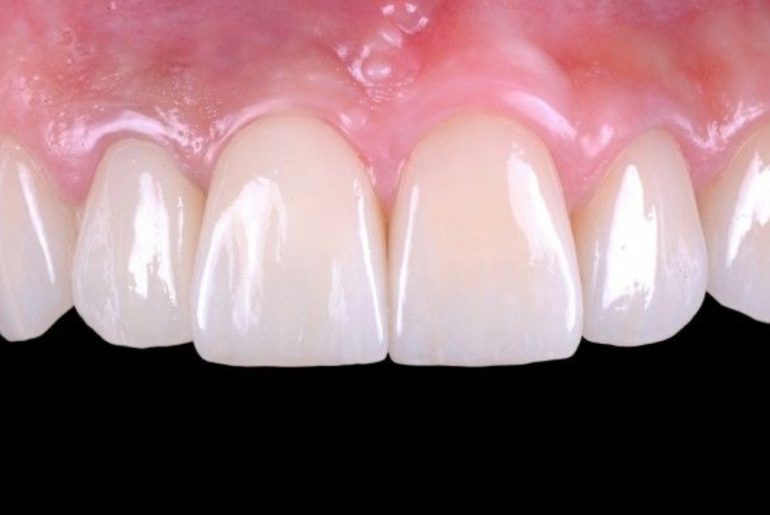 Dental Restoration Different Types of Aesthetic Dental Fillings