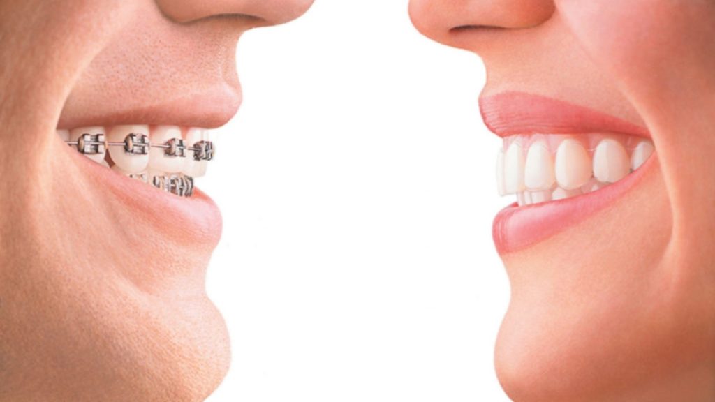 Flaunt an Aesthetically Pleasing Dental Alignment With Braces
