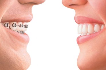 Flaunt an Aesthetically Pleasing Dental Alignment With Braces