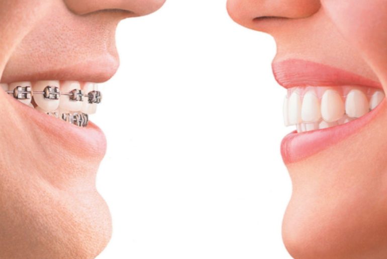Flaunt an Aesthetically Pleasing Dental Alignment With Braces