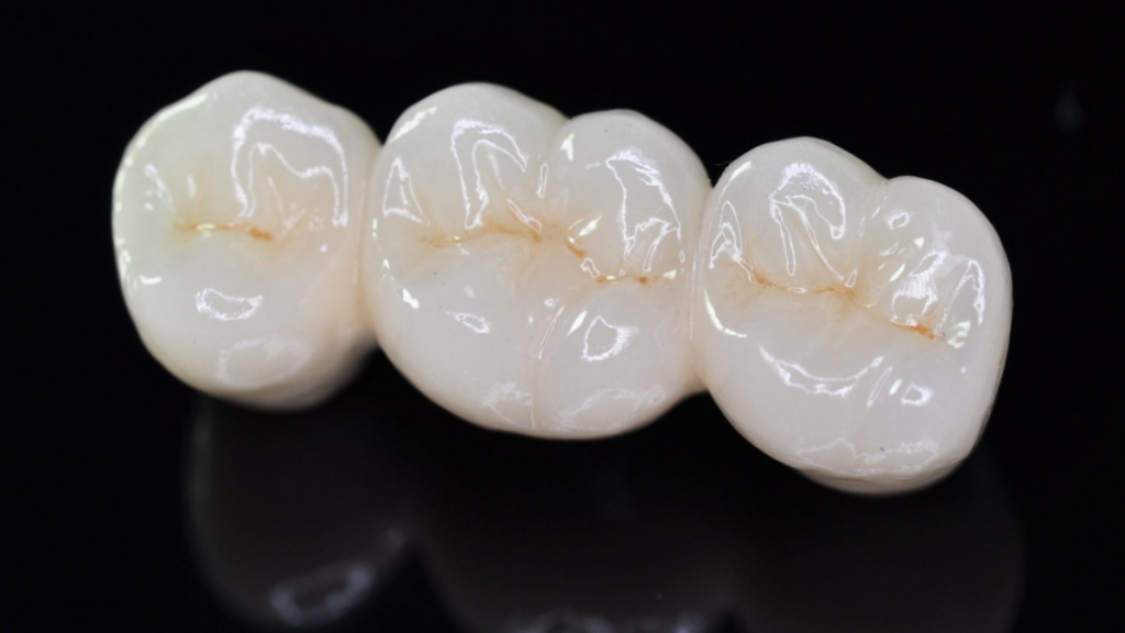 Taking Care of Porcelain Crowns Best Practices To Stick To