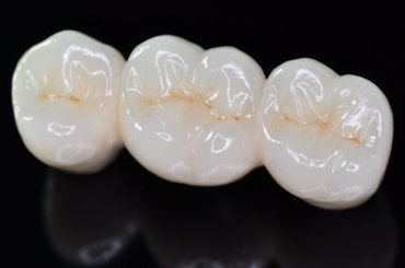 Taking Care of Porcelain Crowns Best Practices To Stick To