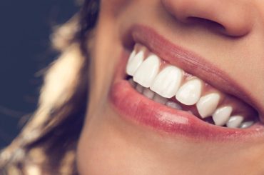Types Of Teeth Whitening Techniques You Can Try In 2022
