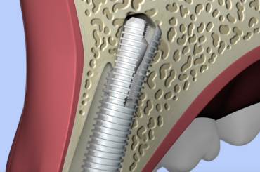 What Are Ultratooth Implants?