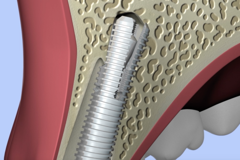What Are Ultratooth Implants?