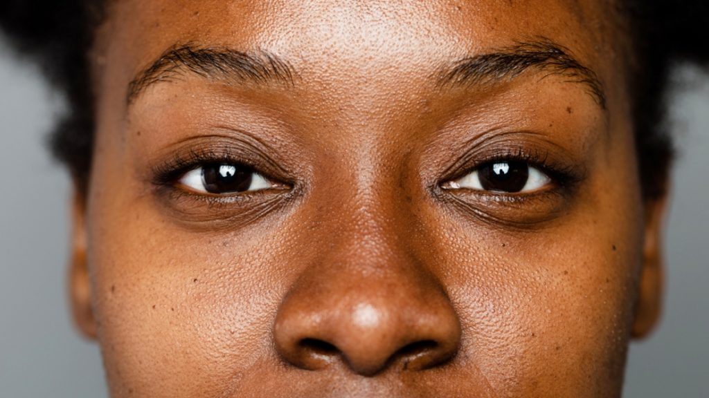 Common Causes of Hyperpigmentation