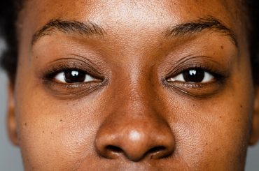 Common Causes of Hyperpigmentation