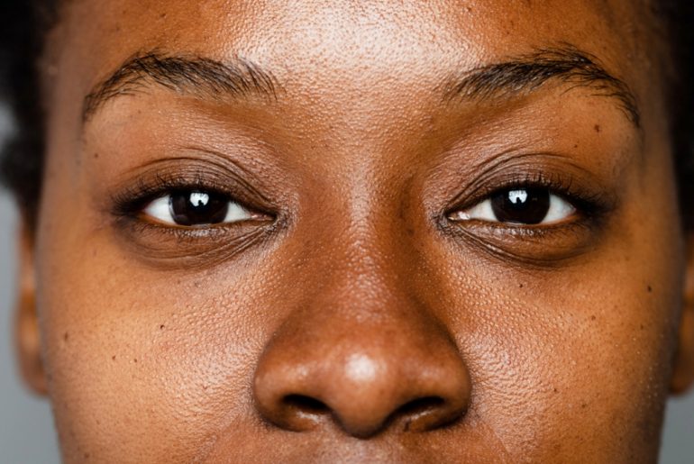 Common Causes of Hyperpigmentation