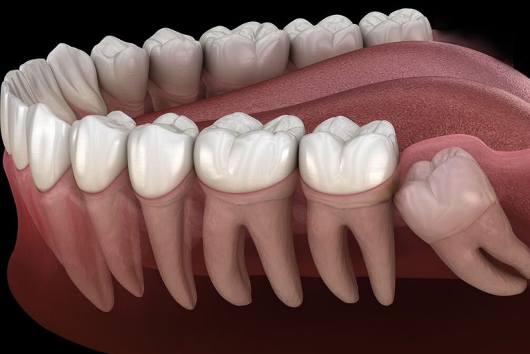 The Procedure for Wisdom Teeth Removal The Procedure for Wisdom Teeth Removal