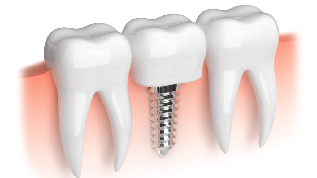 Why Are Dental Implants A Popular Option for Teeth Replacement?