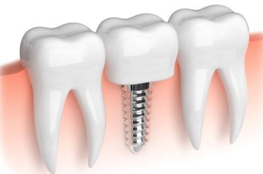 Why Are Dental Implants A Popular Option for Teeth Replacement? Why Are Dental Implants A Popular Option for Teeth Replacement?