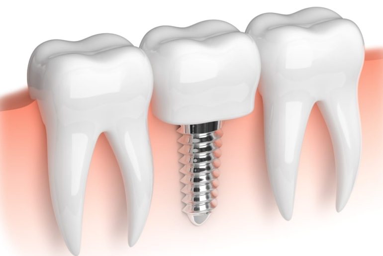 Why Are Dental Implants A Popular Option for Teeth Replacement? Why Are Dental Implants A Popular Option for Teeth Replacement?
