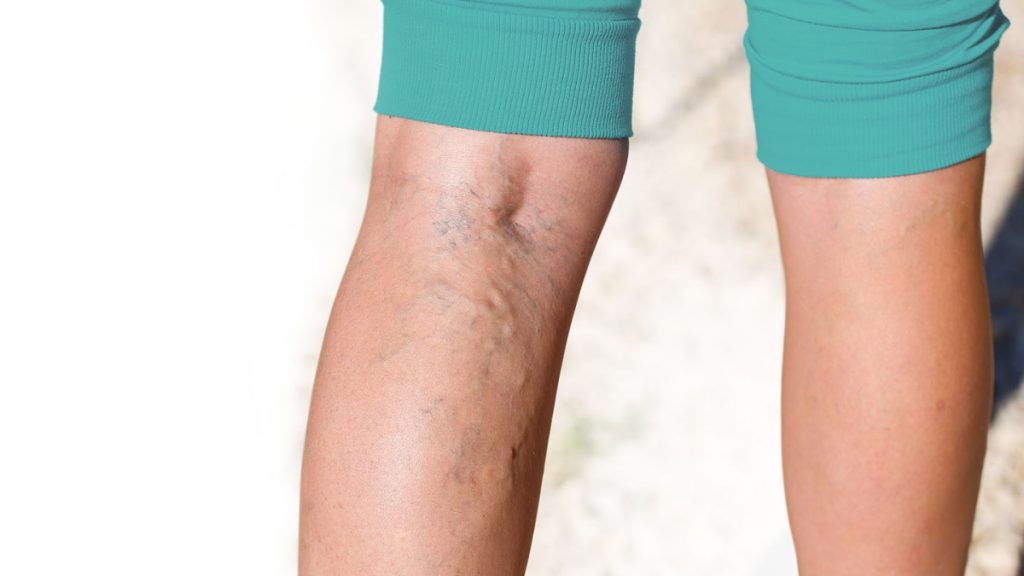 Four Things to Know About Varicose Veins