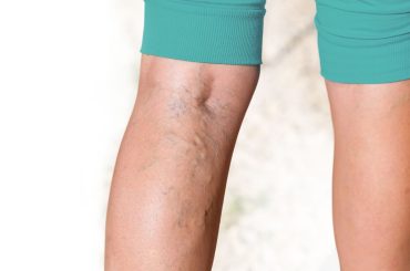 Four Things to Know About Varicose Veins