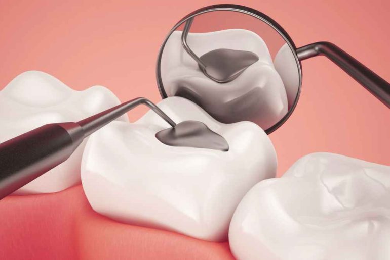 Benefits of Dental Fillings Benefits of Dental Fillings