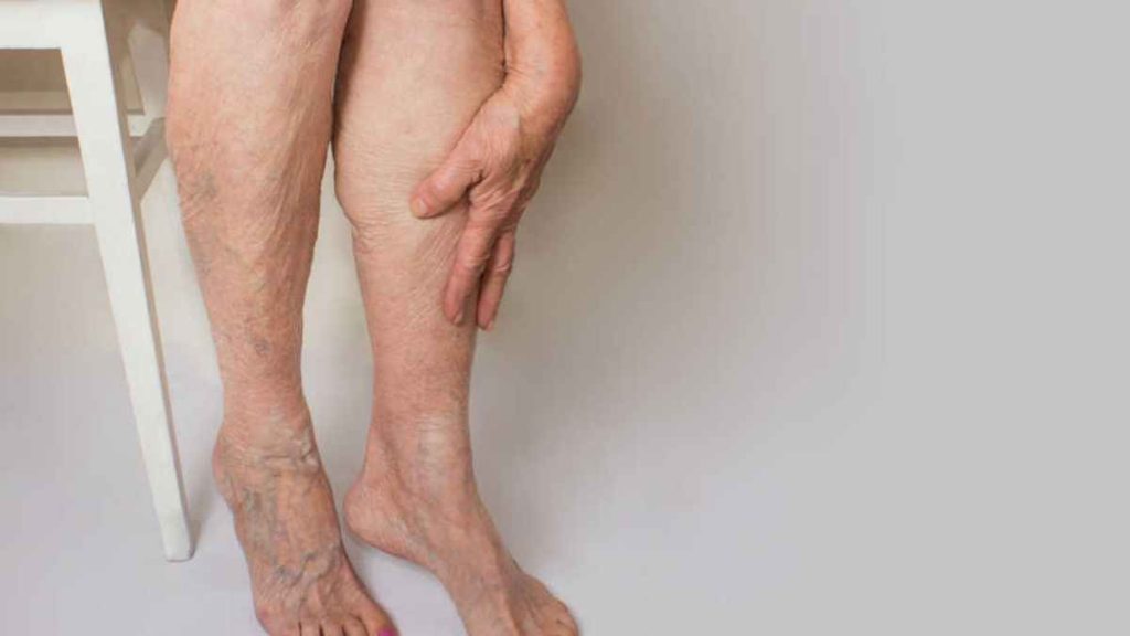 Debunking Myths About Varicose Veins