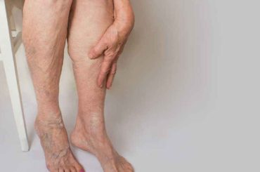 Debunking Myths About Varicose Veins