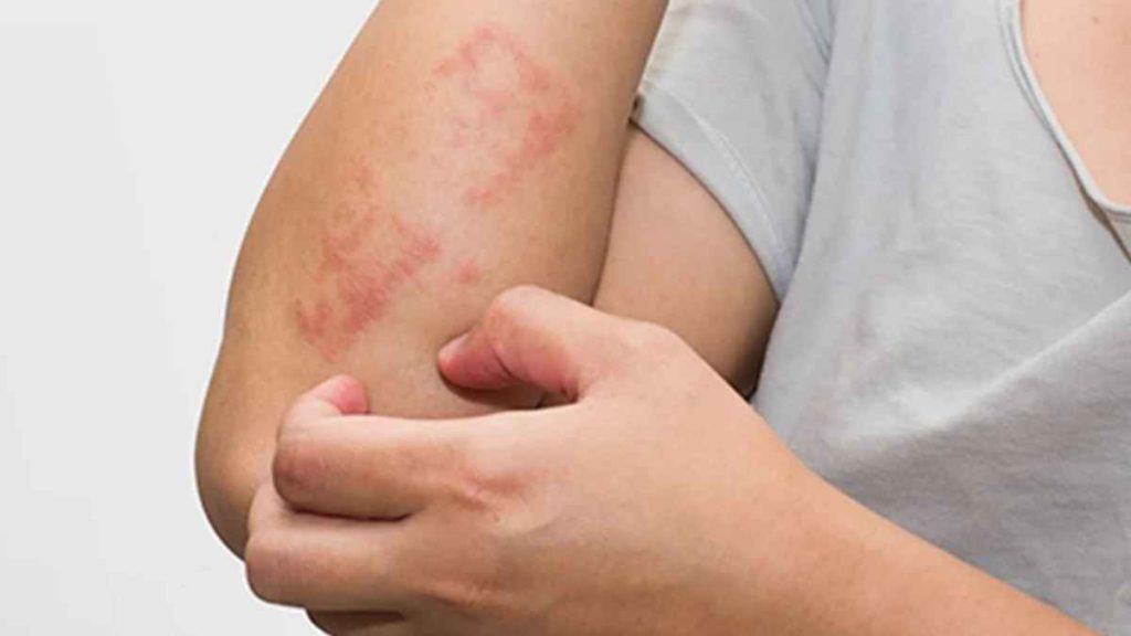 Main Causes of Eczema & Rashes