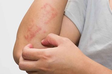 Main Causes of Eczema & Rashes