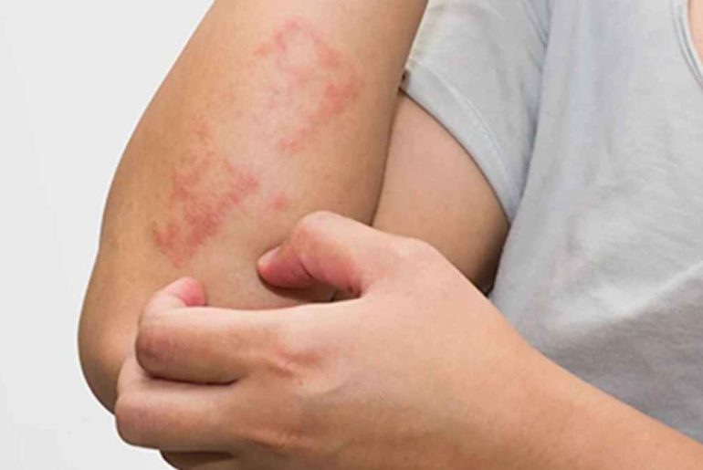 Main Causes of Eczema & Rashes Main Causes of Eczema & Rashes