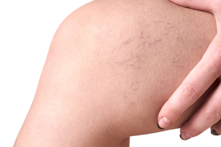 What Takes Place During VenaSeal Surgery? What Takes Place During VenaSeal Surgery?