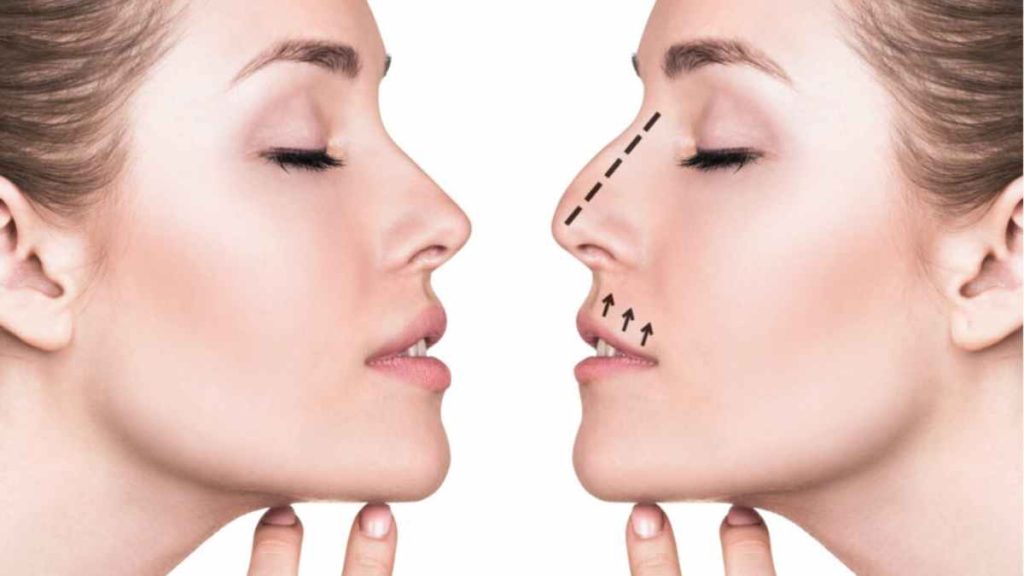 What to Expect During a Rhinoplasty Procedure