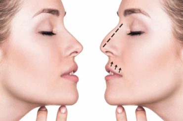 What to Expect During a Rhinoplasty Procedure