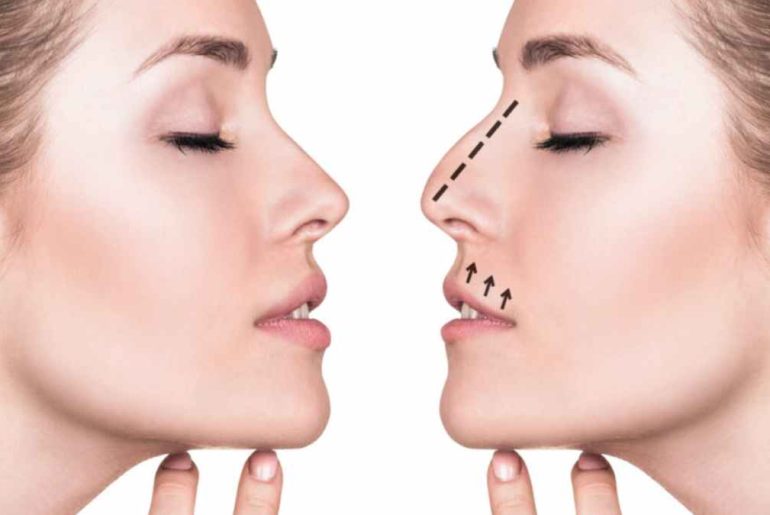 What to Expect During a Rhinoplasty Procedure What to Expect During a Rhinoplasty Procedure