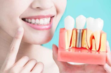 Is The Ultratooth The Ultimate Modern Dentistry Procedure?