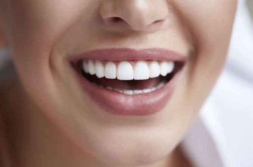 5 Major Steps of Using Veneers to Fix Crooked Teeth