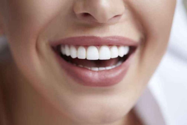 5 Major Steps of Using Veneers to Fix Crooked Teeth