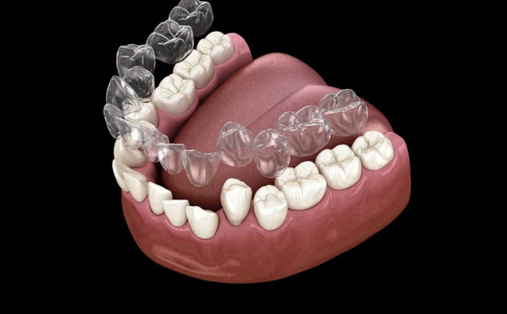 Outstanding Benefits of Having Retainers