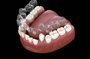 Outstanding Benefits of Having Retainers
