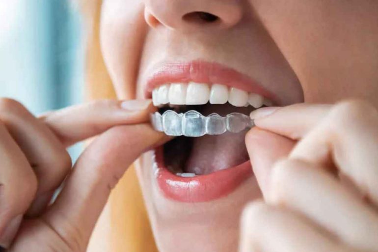 Tips to Help You Take Care of Your Invisalign Aligners