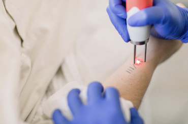 What Is Laser Tattoo Removal?