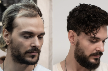 What is Non-Surgical Hair Restoration?