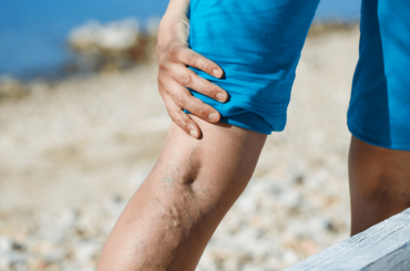 What  Varithena Entails