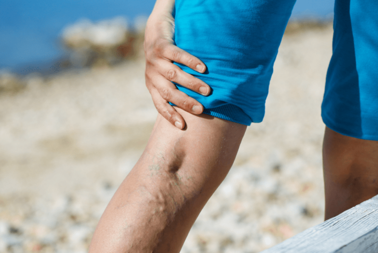 What  Varithena Entails