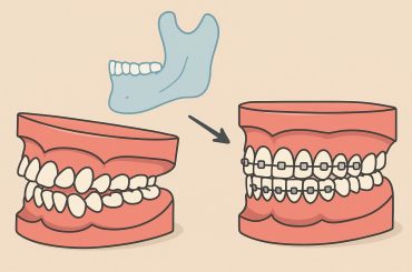 Braces adjusting teeth for proper jaw alignment, illustrating orthodontic treatment benefits